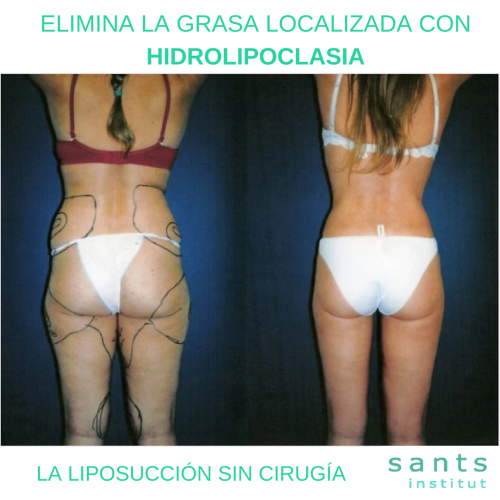HIDROLIPOCLASIA